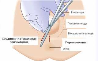 Швы после родов