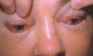 Особенности лечения трихинеллеза