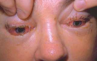 Особенности лечения трихинеллеза