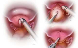 Что за операция абдоминальная миомэктомия, и в каких случаях она проводится?