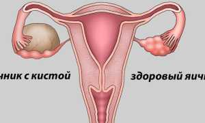 Выделения при кисте яичника