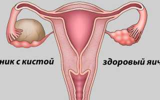 Выделения при кисте яичника