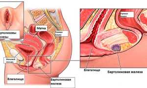 Киста бартолиновой железы – причины возникновения образования