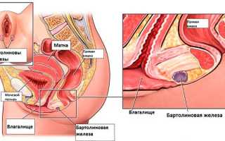 Киста бартолиновой железы – причины возникновения образования