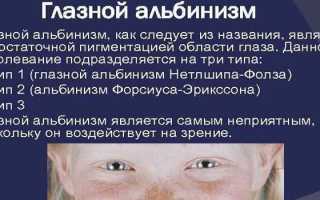 Альбинизм у человека — причины, симптомы и диагностика заболевания