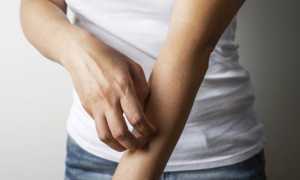 Чешется кожа при псориазе или нет?