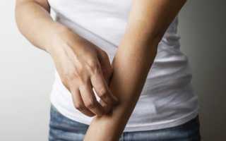 Чешется кожа при псориазе или нет?