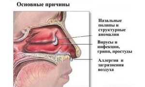 Сфеноидит острый и хронический — симптомы и лечение