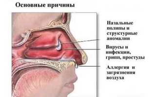 Сфеноидит острый и хронический — симптомы и лечение