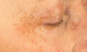 Паразитарные заболевания кожи