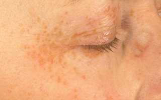 Паразитарные заболевания кожи