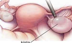 Симптомы разрыва кисты яичника