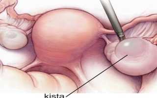 Симптомы разрыва кисты яичника