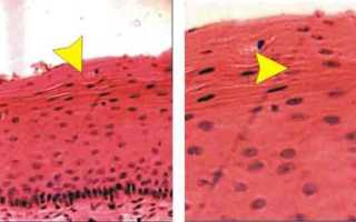 Противопоказан ли секс при лейкоплакии матки?
