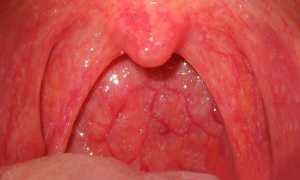 Можно ли вылечить ангину без антибиотиков