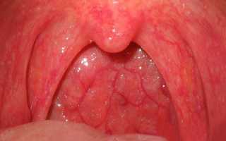 Можно ли вылечить ангину без антибиотиков