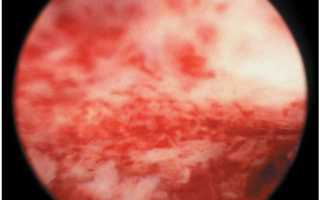 Как протекает сложная гиперплазия эндометрия?