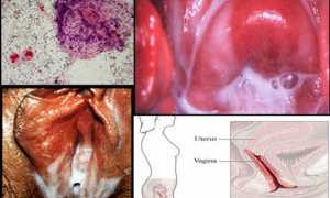 Причины возникновения бактериального кандидоза и методы лечения