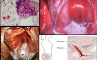 Причины возникновения бактериального кандидоза и методы лечения