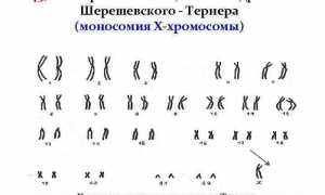 Формы и лечение синдрома Шерешевского-Тернера
