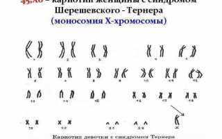 Формы и лечение синдрома Шерешевского-Тернера