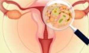 Есть ли вероятность, что молочница пройдет без лечения?