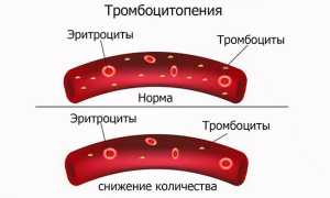 Признаки гестоза при беременности на различных сроках — типы патологии и стадии течения