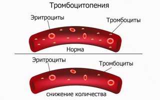 Признаки гестоза при беременности на различных сроках — типы патологии и стадии течения
