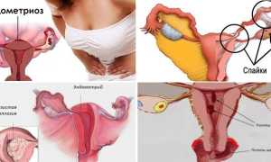 Гистеросальпингография маточных труб — как проводится процедура