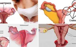 Гистеросальпингография маточных труб — как проводится процедура