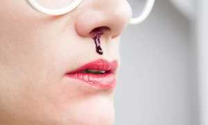 Лечение носовых кровотечений у взрослых и детей