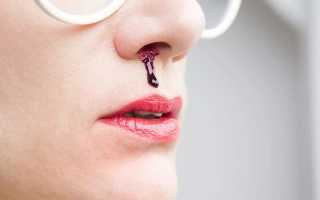 Лечение носовых кровотечений у взрослых и детей