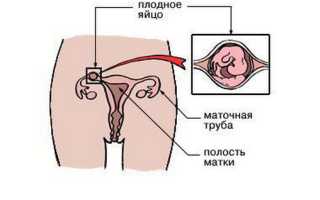 Как развивается первая внематочная беременность?