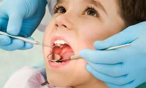 Кариес молочных зубов – что делать ?