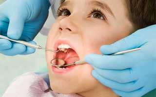 Кариес молочных зубов – что делать ?