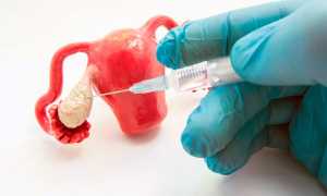 Короткий протокол ЭКО: подробно о короткой схеме стимуляции