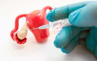 Короткий протокол ЭКО: подробно о короткой схеме стимуляции