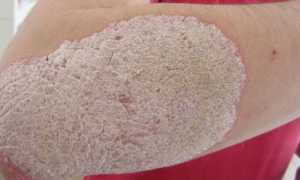 Стадии псориаза и лечение