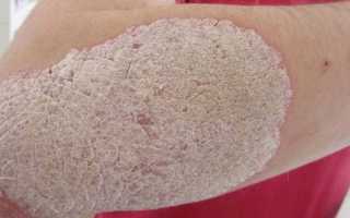 Стадии псориаза и лечение