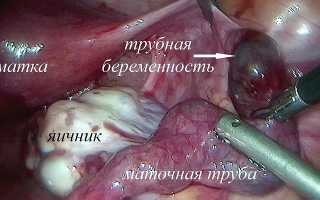 Виды выделений при внематочной беременности