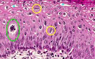 Койлоцитоз шейки матки: что это такое и как его вылечить?