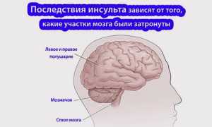 Обширный ишемический инсульт