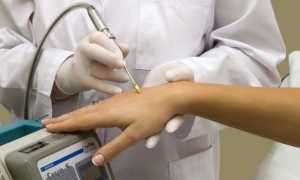 Удаление бородавок жидким азотом — описание процедуры