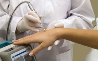 Удаление бородавок жидким азотом — описание процедуры