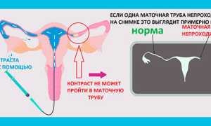 Как проверить проходимость маточных труб правильно