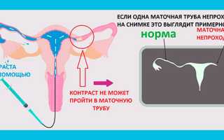 Как проверить проходимость маточных труб правильно