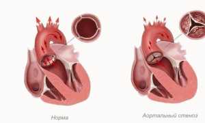 Коронарография – что это: как проводят исследование сердца и сосудов