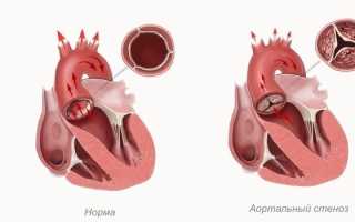 Коронарография – что это: как проводят исследование сердца и сосудов