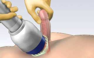 Новое в лечении болезни Пейрони — лекарственные препараты и хирургическое вмешательство