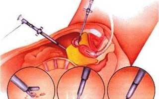 Как проводится коагуляция очагов эндометриоза?